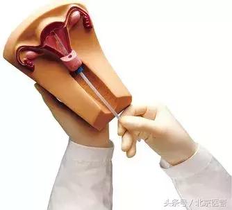 节育环出血的时候能取出来吗,节育环出血时能去取吗