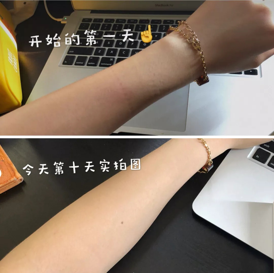 坚持7天的细纹消失,没有细纹但是有斑点