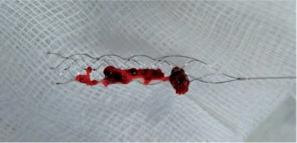 急性脑梗塞治疗指南pdf,急性脑梗塞介入取栓治疗有风险吗