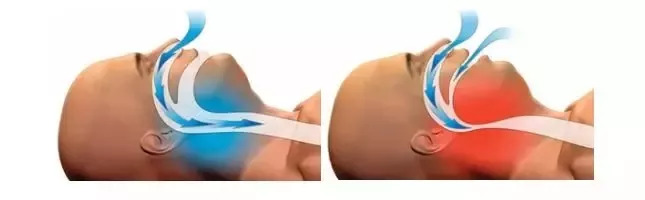 打鼾很严重能治吗,打鼾致命吗