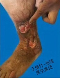 静脉曲张详细解说,静脉曲张知识大全书籍