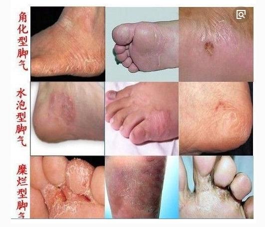 脚气容易引起灰指甲吗,脚气与灰指甲交叉感染了怎么办