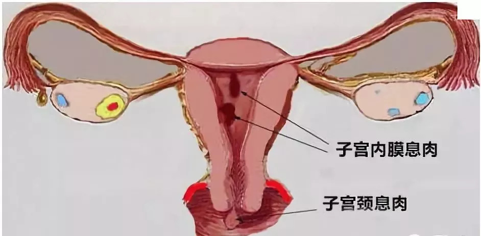 肠息肉和胆囊息肉必须做手术吗,有肠息肉胃息肉胆囊息肉怎么办