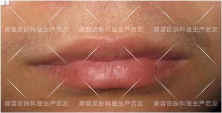 上海面部激光脱毛,正确认识皮肤