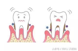 一颗智齿会带来什么危害,一颗智齿惹的祸