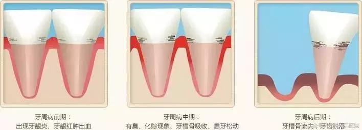 一颗智齿会带来什么危害,一颗智齿惹的祸