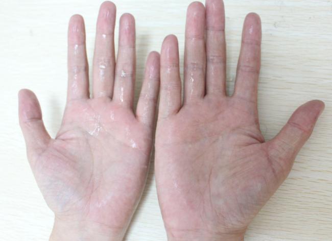 两个人握手手心为什么会出汗,跟人握手手心有汗怎么办