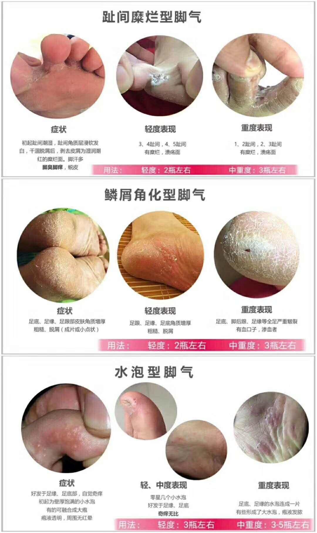 脚气用什么药膏涂抹好得快,脚气的克星有哪些药膏