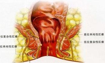 肛门附近脓包溃烂后形成肛瘘吗？