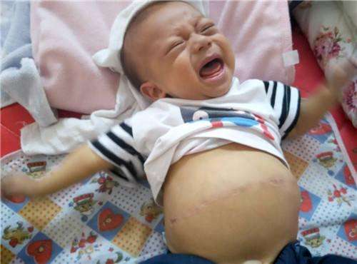 3个月宝宝疝气哭闹怎么办,新生儿腹股沟疝气护理知识