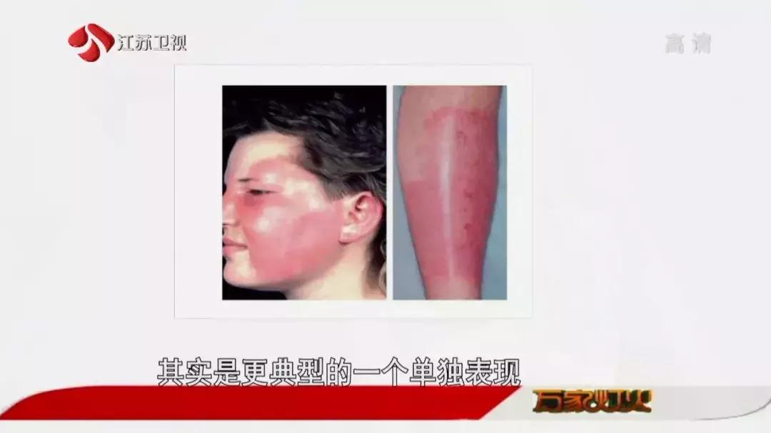 经常去足疗会得脚气吗,去洗脚感染脚气怎么办