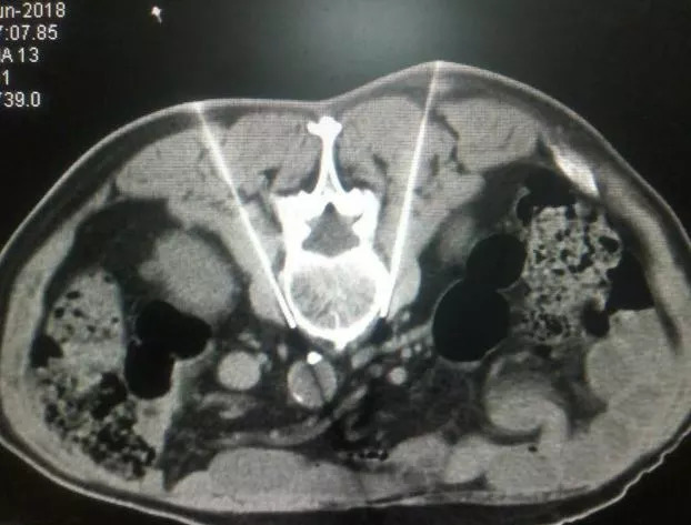 抖腿有啥病,抖腿是一种心理疾病