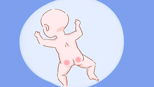 尿布疹和湿疹,宝宝湿疹和尿布疹各种最佳图片