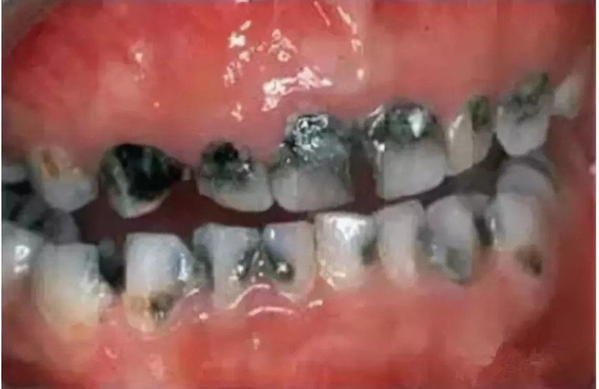 几岁的儿童牙齿就烂了是什么原因,宝宝牙齿烂光了只剩下牙根怎么办