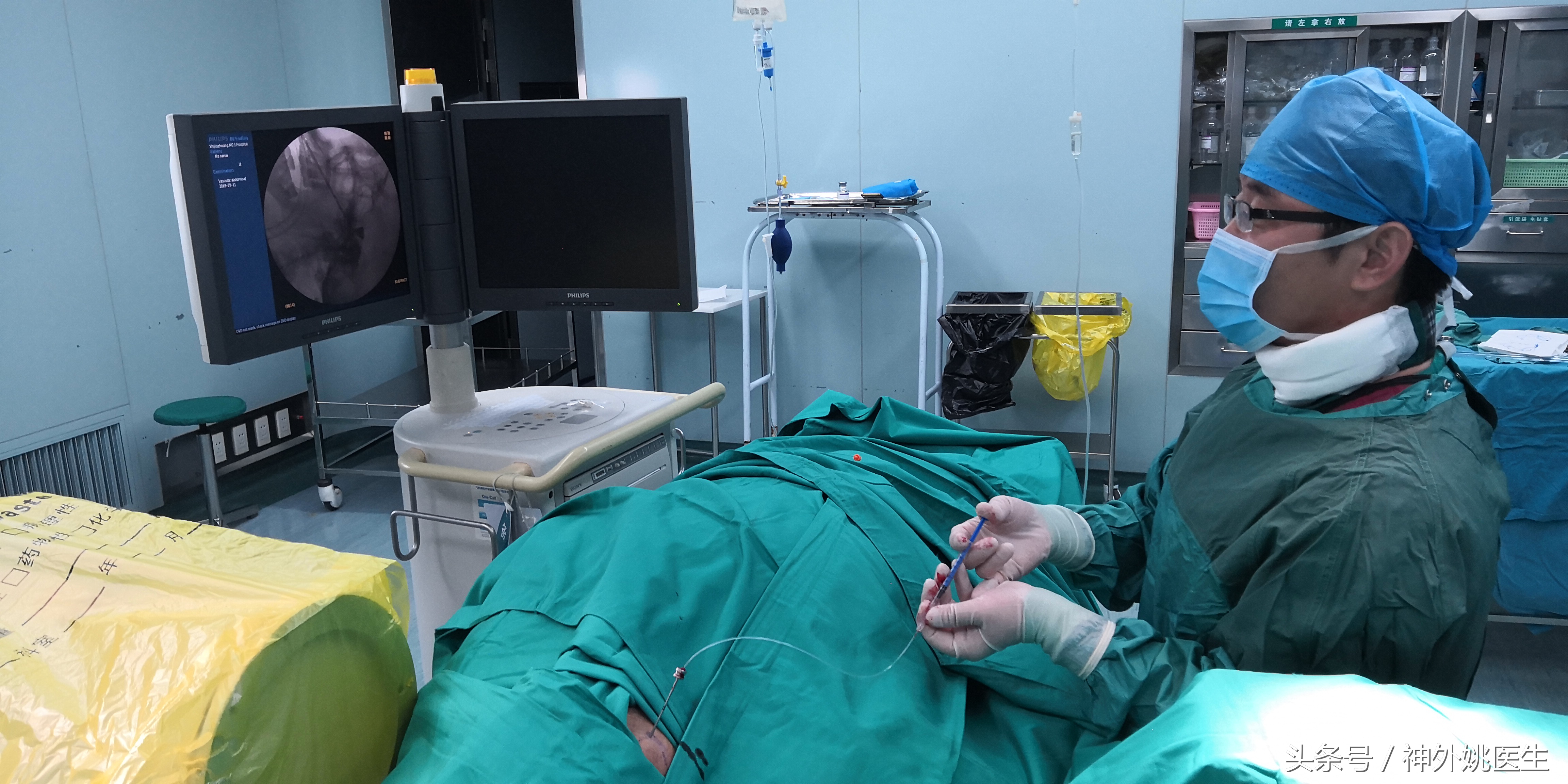 经皮三叉神经球囊压迫术穿刺路径,经皮穿刺三叉神经球囊压迫术