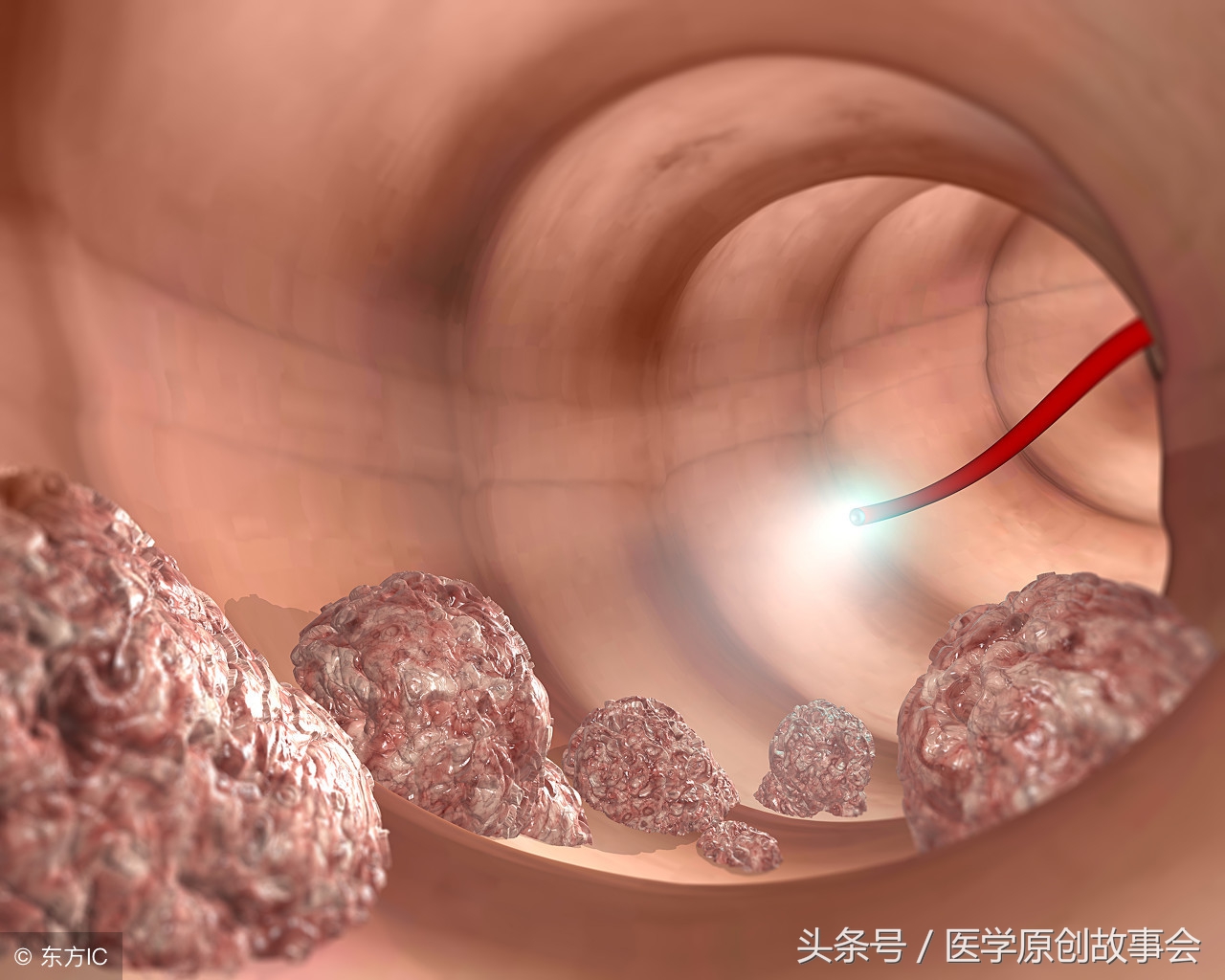 皮肤上这种痣十有八九是黑斑息肉，出现了一定要及时检查