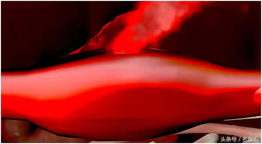 怎样治静脉曲张和蚯蚓腿,下肢静脉曲张如何去掉小蚯蚓