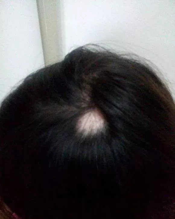 脱发千万别轻信偏方医生告诉你,你还在脱发吗