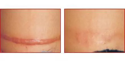 What？高血压降压药还能用来治疤痕？义乌这位整形专家耗费5年时间，取得科研新突破！