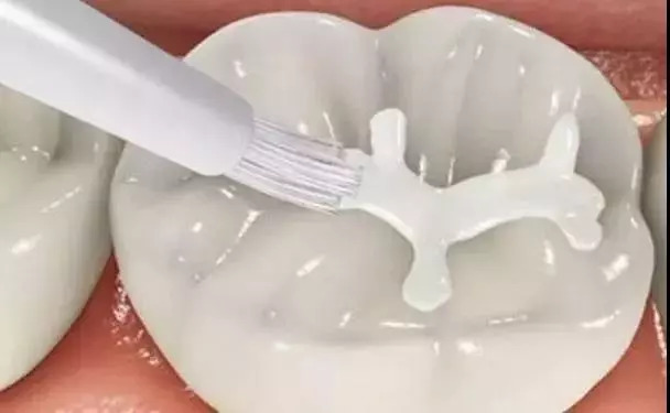 广州哪些医院免费做牙齿窝沟封闭,千万不要窝沟封闭