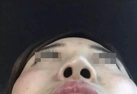 为什么有的人隆鼻成功有的失败,揭秘医生都不会说的隆鼻内幕