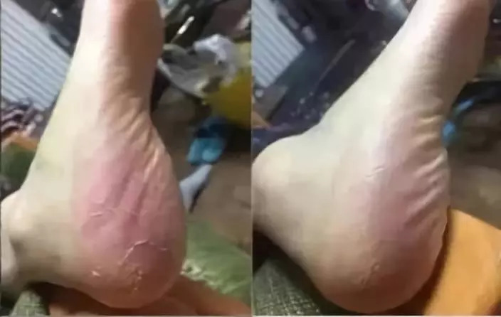 脚干裂脱皮的必备神器,脚部干裂起皮涂它全好了