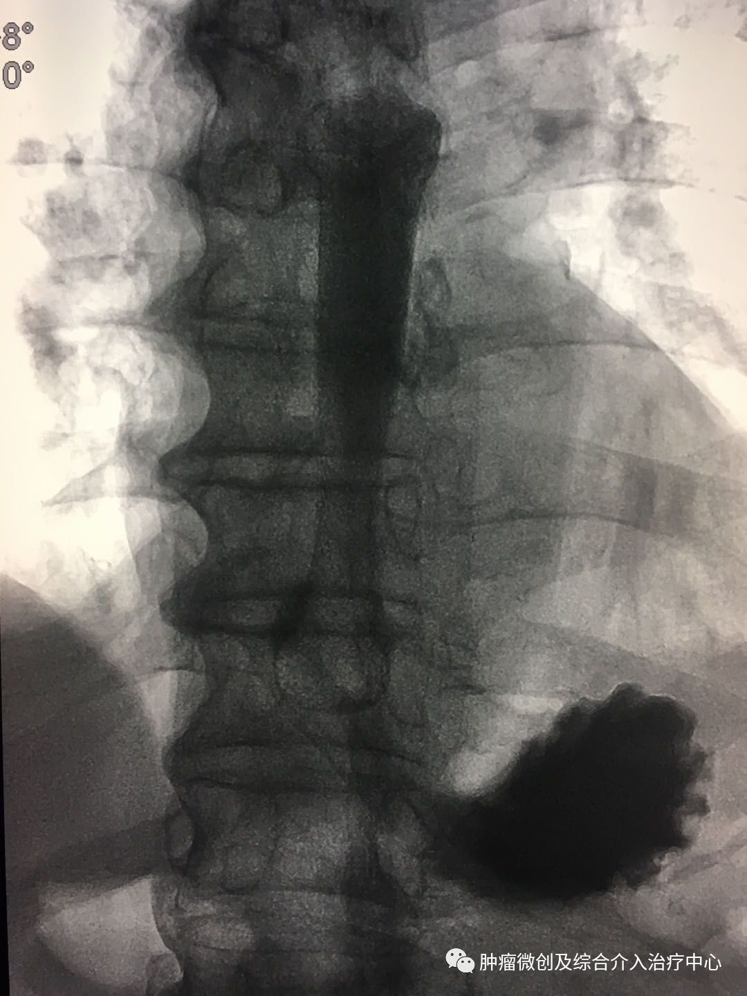 食道癌晚期介入治疗,山西肿瘤医院介入科食管癌