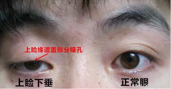 老是感觉上眼皮耷拉怎么回事,老是眼皮跳是什么病