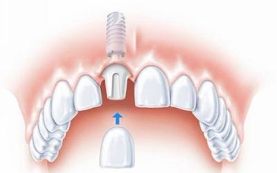 带您了解牙齿,种植牙科普30秒