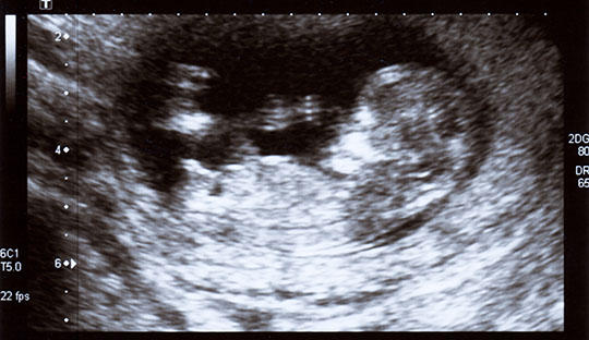 孕早期nt检查胎儿不动怎么才能动,孕早期先做nt还是先建档检查