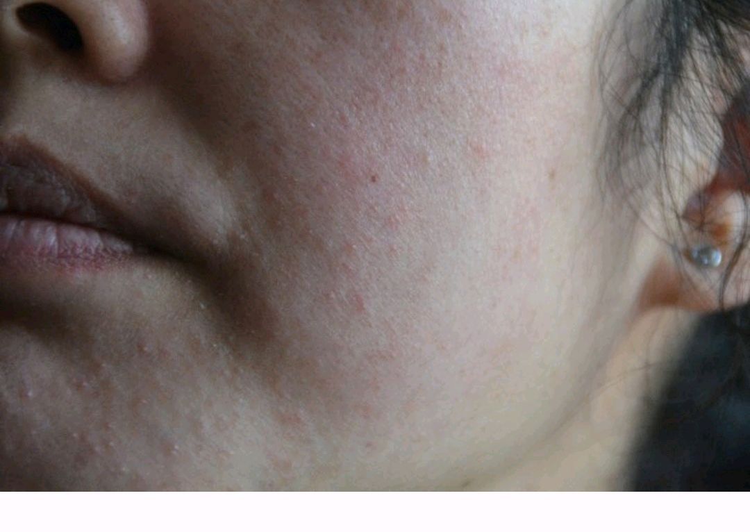 果酸焕肤有用吗,果酸换肤祛斑吗