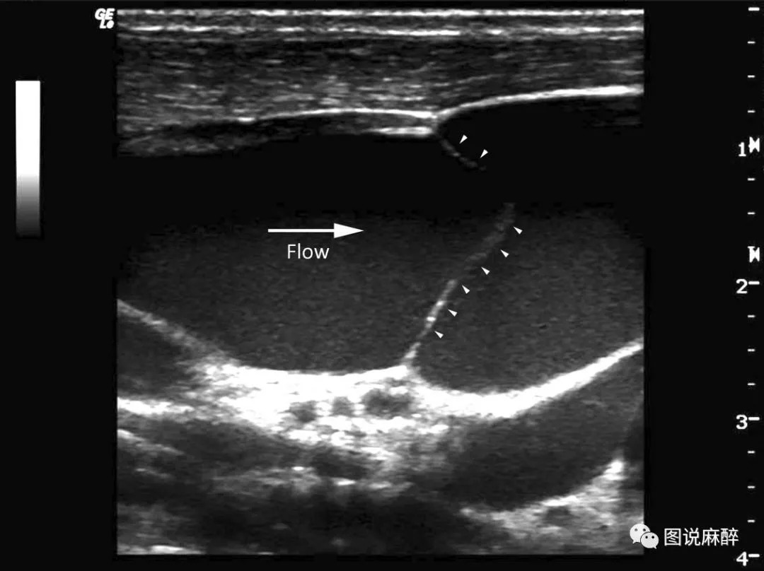 深静脉穿刺置管术拔出后疼痛,深静脉穿刺置管深度一般多少厘米