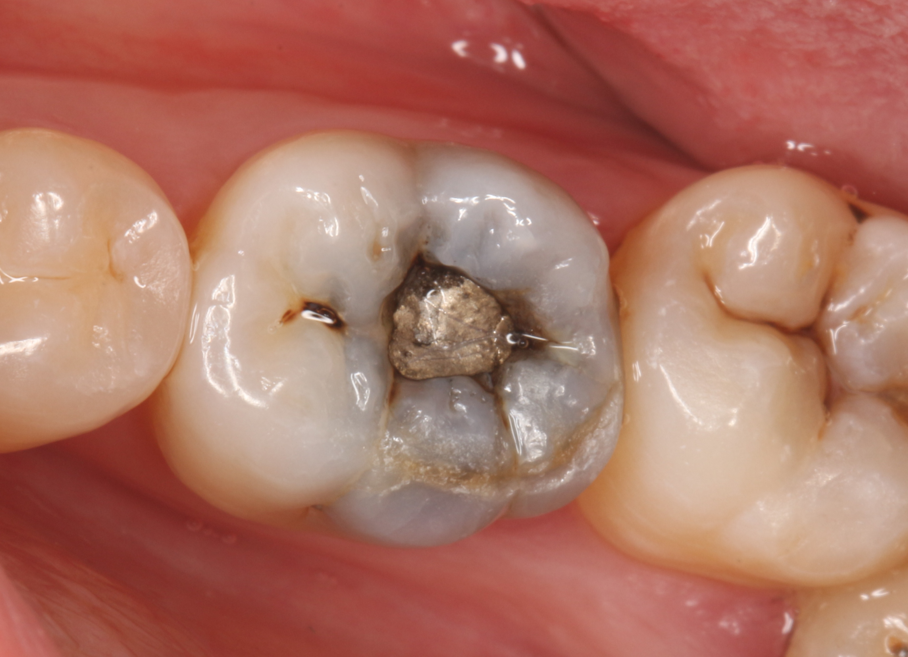 浅隐裂牙怎么处理,隐裂牙有自愈的可能