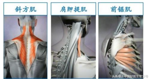 翼状肩胛骨矫正最快的方法,翼状蝴蝶骨矫正