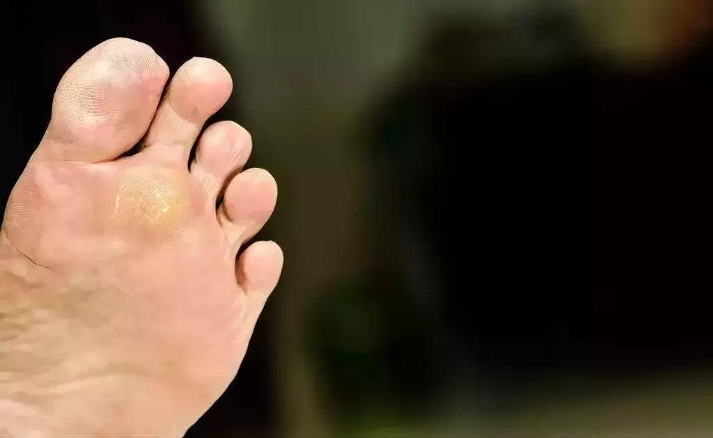 脚磨破皮不爱愈合，医生说怕是得了这种病！真希望你早点发现