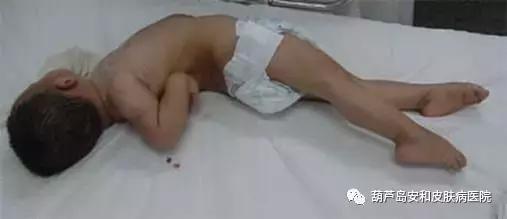 几年前打的破伤风针现在还有用吗,以前打了破伤风针现在还有效果