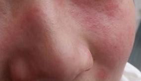 面部线雕失败全过程,面部线雕失败的图片