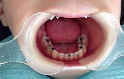 口腔矫正的十大误区,口腔误区