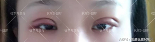 实例：全切双眼皮术后15天变化全程记录