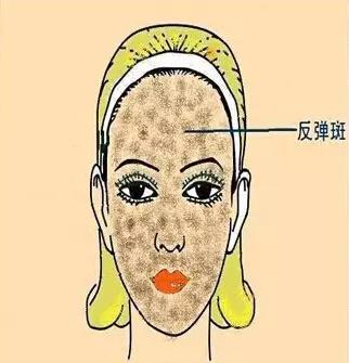 色斑一般在什么位置,你知道色斑分几个种类吗