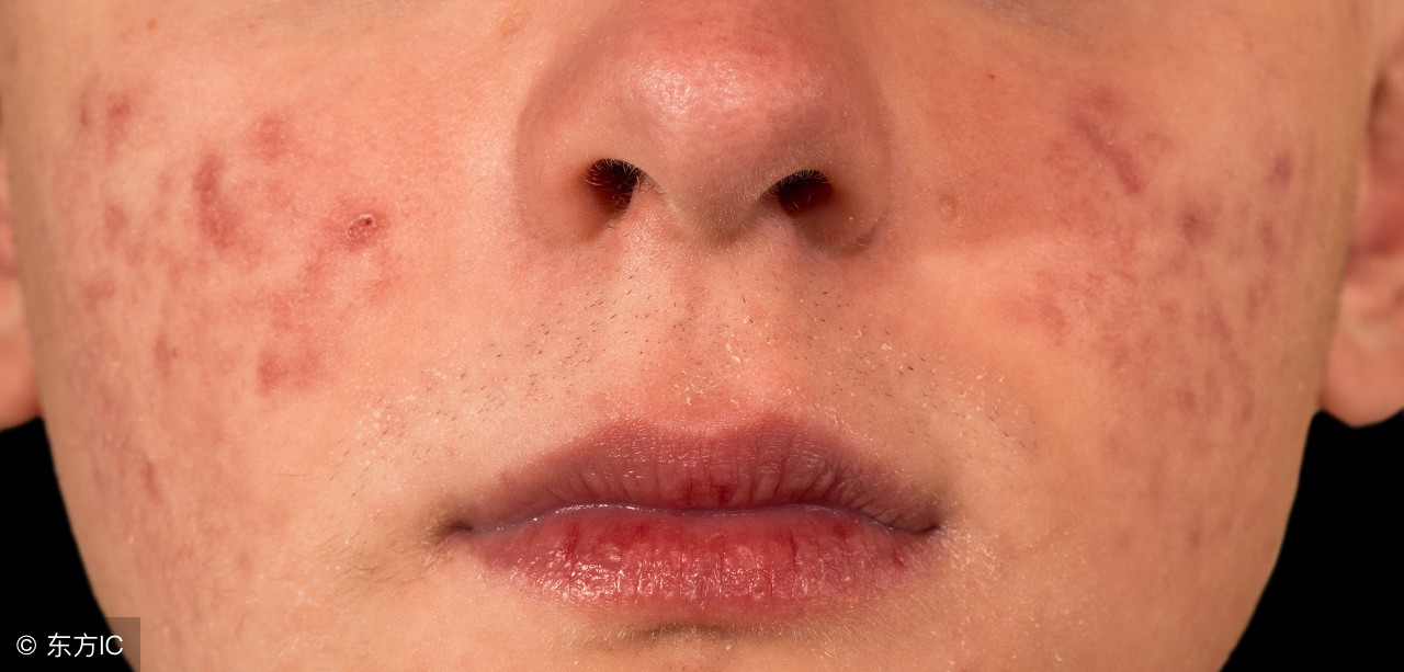 湿气重如何抗衰老和美白肌肤,湿气重气血不足怎么减重