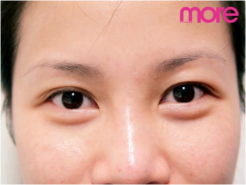 9大秘籍轻松搞定黑眼圈,有效快速解决黑眼圈的方法