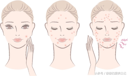 痘痘挤出来白色的东西是什么痘痘,白色硬硬的痘痘挤出来白色的东西