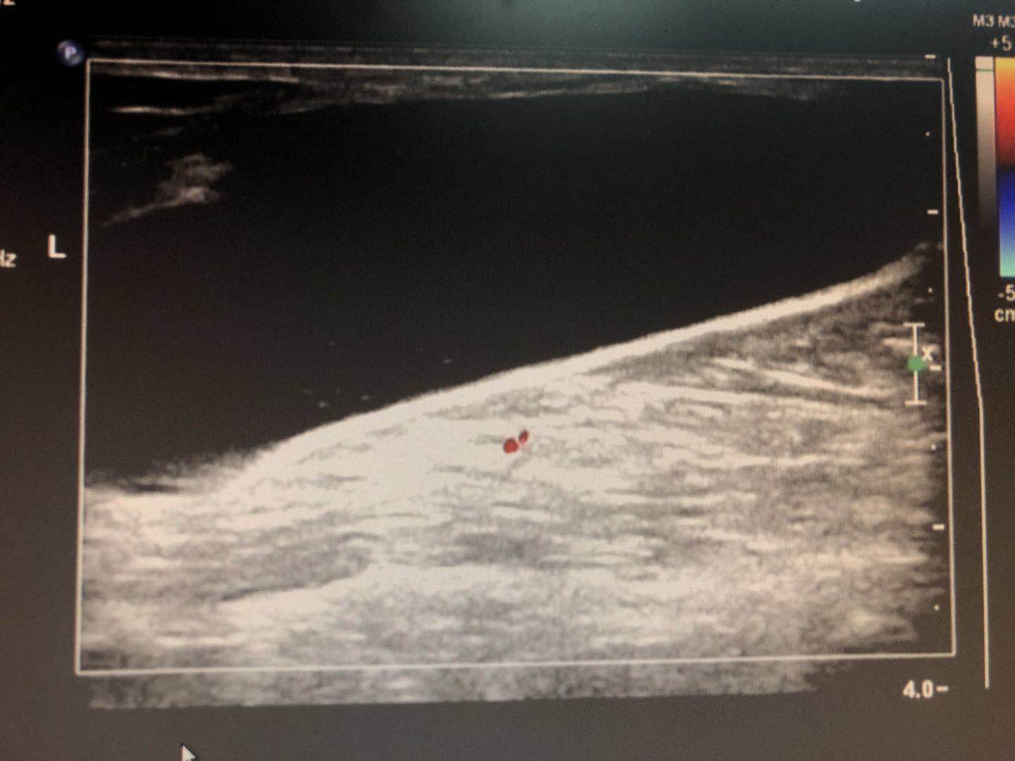 囊肿就是瘤吗,囊肿就是结节吗