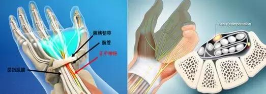 手麻、无力、肌肉萎缩？——你可能得了腕管综合征