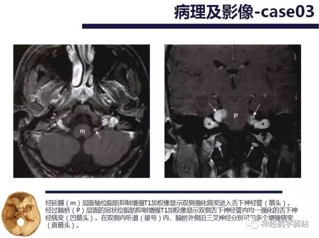 舌下神经和舌咽神经的解剖图,颊神经舌神经解剖图