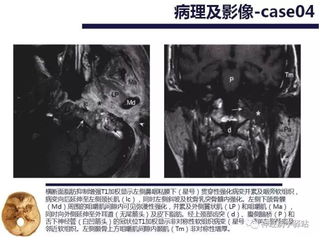舌下神经和舌咽神经的解剖图,颊神经舌神经解剖图