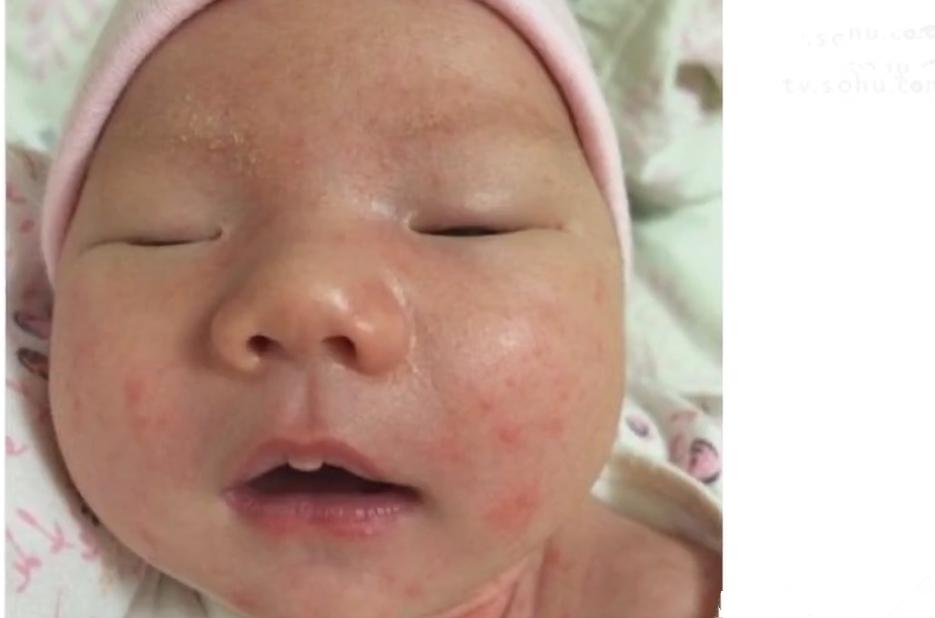 宝宝脸上长湿疹妈妈饮食注意什么,宝宝湿疹妈妈好心疼