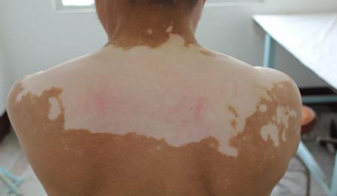 如果白癜风十年没复发还会复发吗,白癜风全身变白之后会怎么样