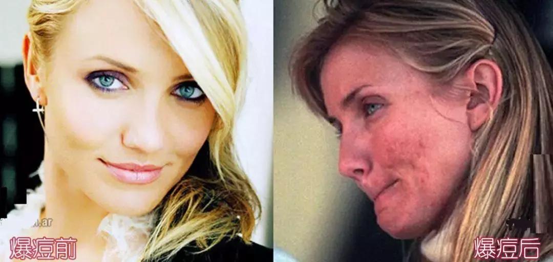 战痘技巧｜林允儿和小甜甜的痘痘可不是一回事